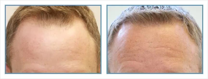 Before and after men's hair transplant - NW3v - 1,100 FUs - Frontal / Crown