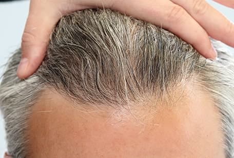 Natural-looking hairline result from FUE hair transplant