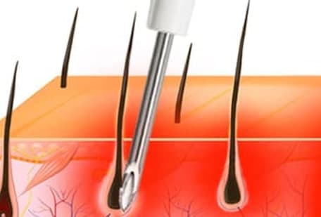 Illustration showing minimal scarring from FUE punch
