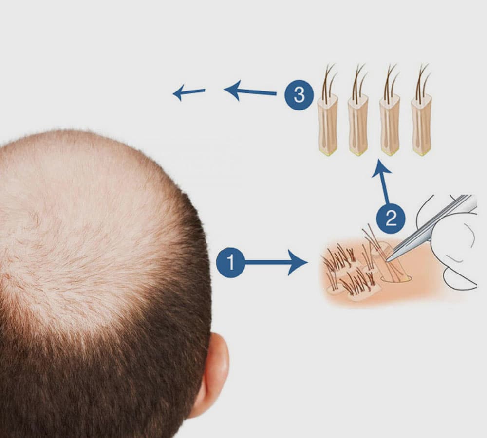 Close-up illustration of FUE hair follicle extraction technique