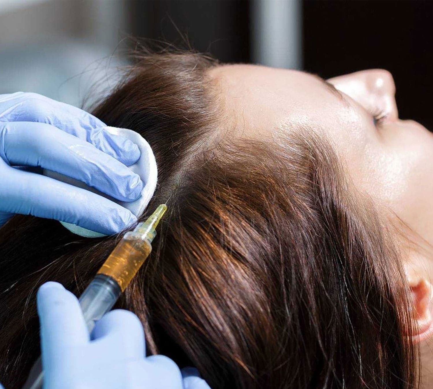 PRP treatment for hair loss