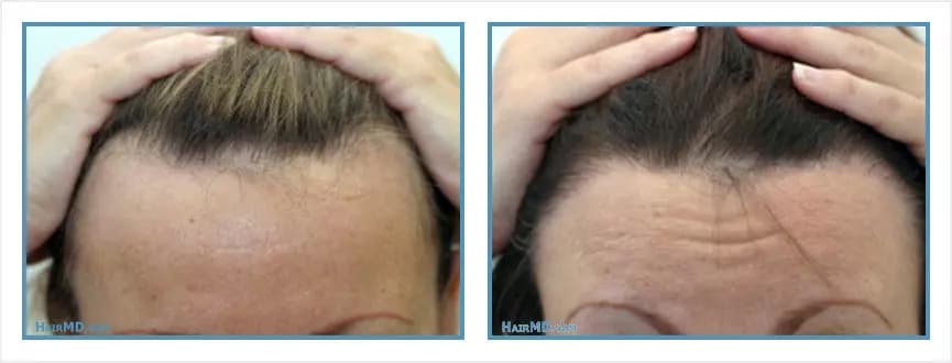 Before and after women's hair transplant - LW Frontal - 1,600 FUs - Hairline