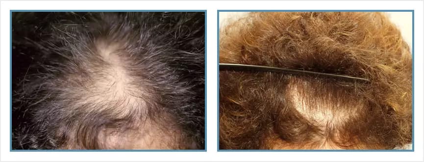 Before and after women's hair transplant - LW1 - 1,000 FUs - Frontal Area