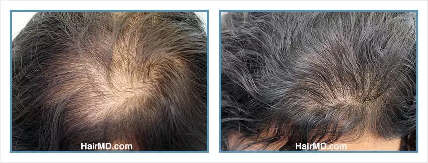 Before and after women's hair transplant - LW2 - 1,200 FUs - Frontal Area