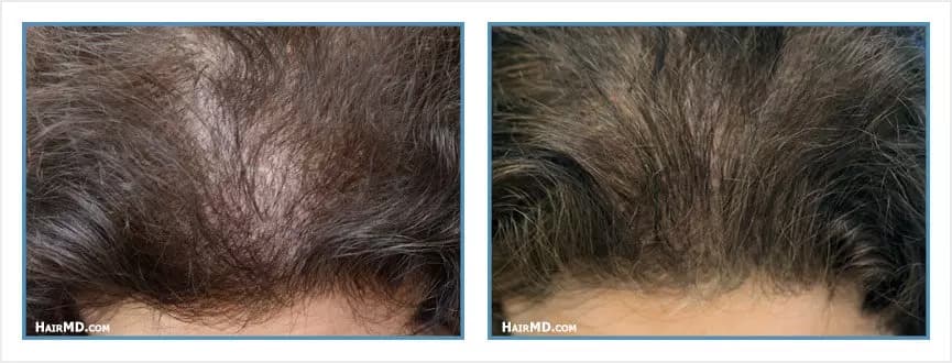 Before and after women's hair transplant - LW2 - 2,100 FUs - Frontal Area