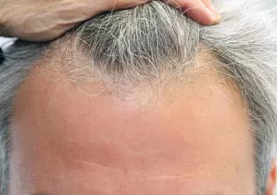 Before FUE hair transplant for male patient at HAIRMD