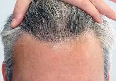 After FUE hair transplant result for male patient at HAIRMD Englewood NJ