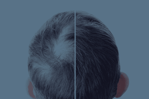 Hair Transplant Success Stories: Before and After