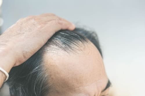 Exactly What To Expect From Hair Transplant Surgery