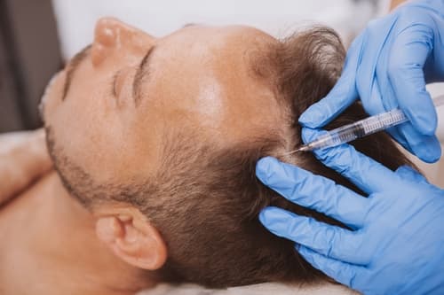 My Journey To Reverse Thinning Hair Using PRP Therapy with Exosomes