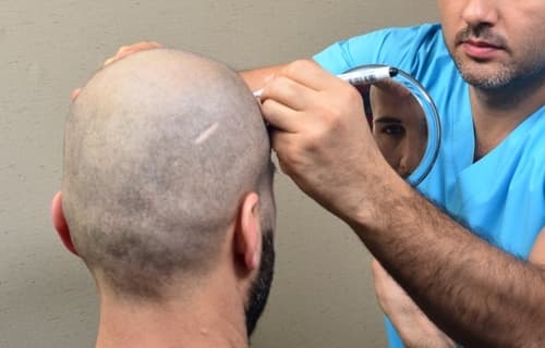 FUT Hair Transplant—What Is Follicular Unit Transplantation?