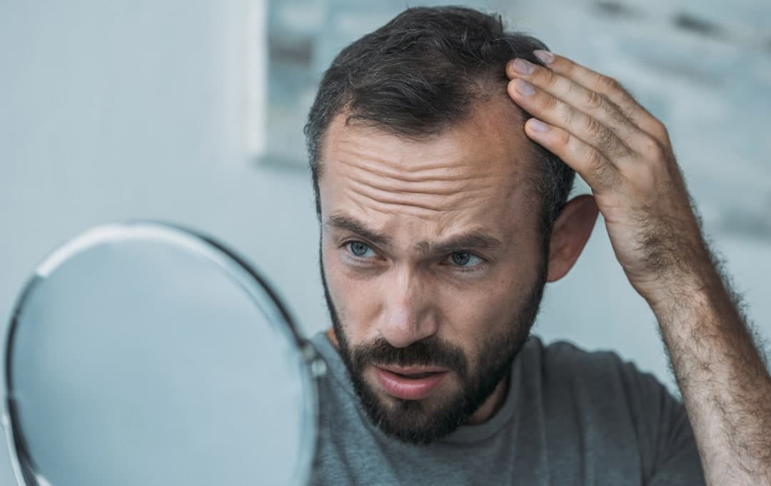 The Most Common Hair Loss Causes (And a Few Obscure Ones)