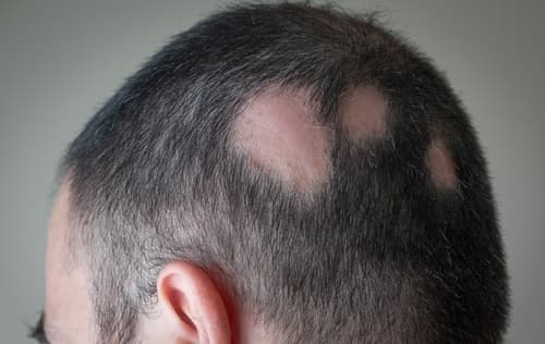 Understanding Alopecia Areata—Signs, Types, and Treatments