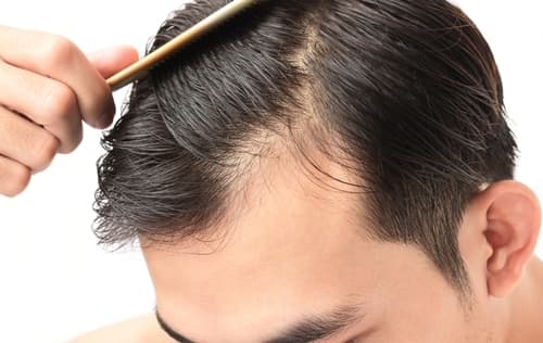 The Relationship Between DHT & Hair Loss