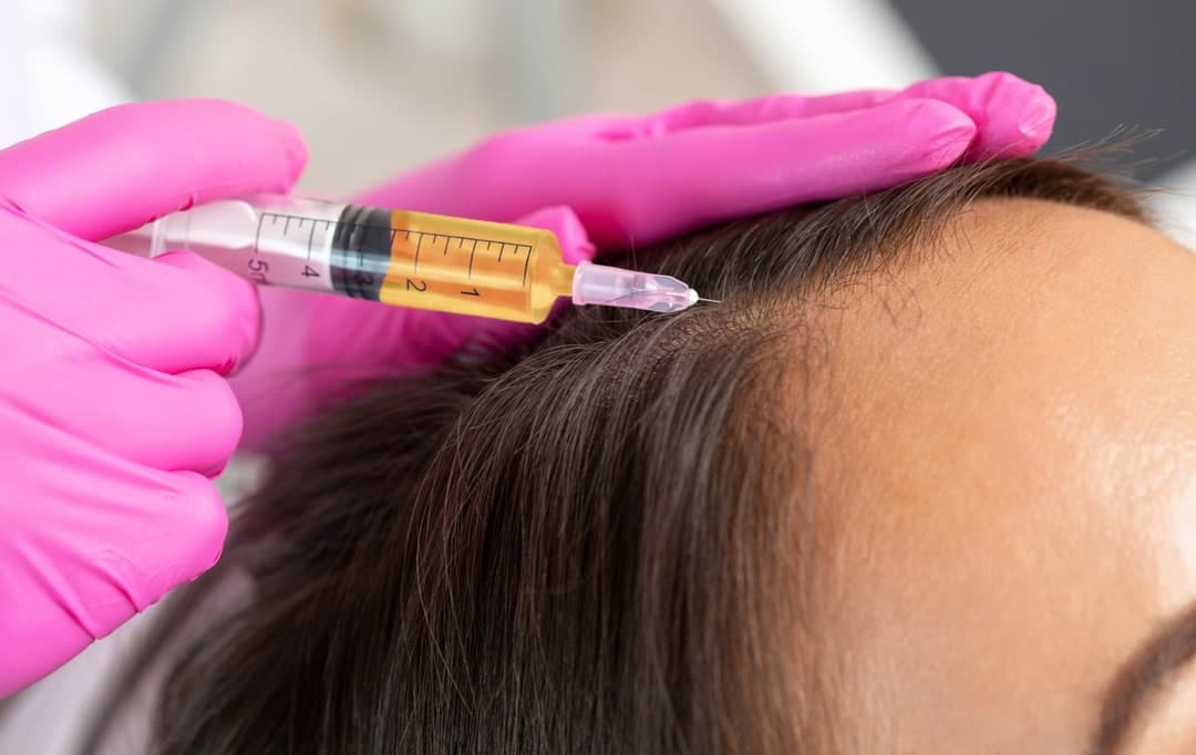 Platelet-Rich Plasma (PRP) for Treating Hair Loss